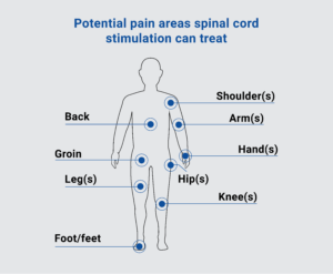 Am I a Candidate for a Spinal Cord Stimulator?: Superior Pain